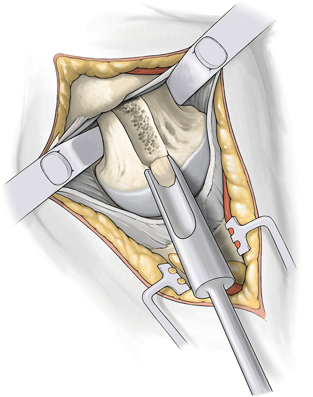 SuperPATH微创全髋关节置换手术入路图解