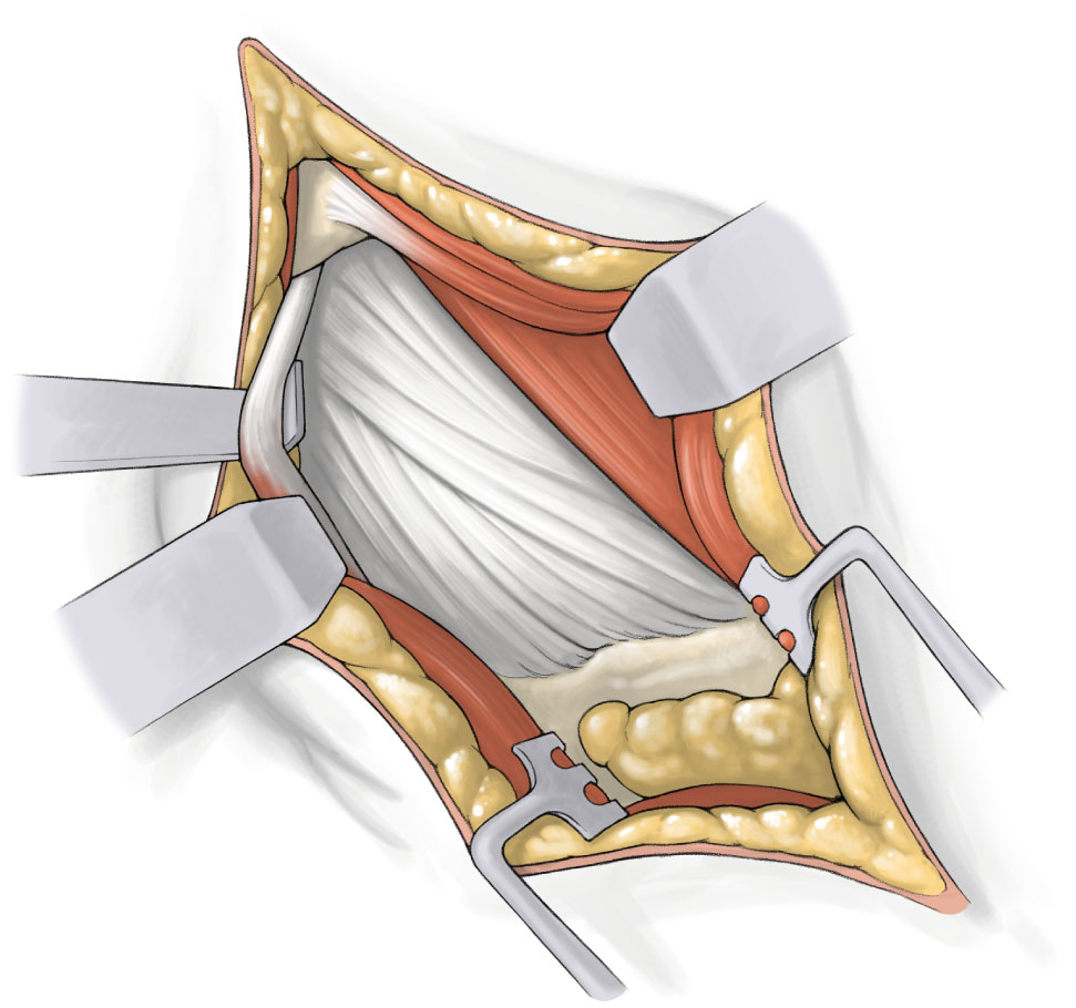 SuperPATH微创全髋关节置换手术入路图解
