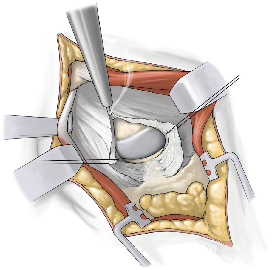 SuperPATH微创全髋关节置换手术入路图解