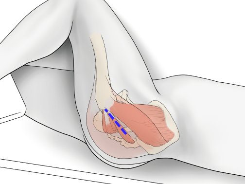SuperPATH微创全髋关节置换手术入路图解