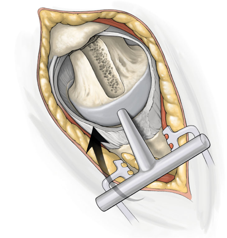 SuperPATH微创全髋关节置换手术入路图解