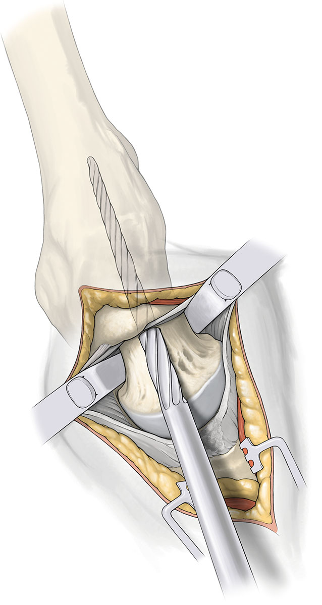 SuperPATH微创全髋关节置换手术入路图解