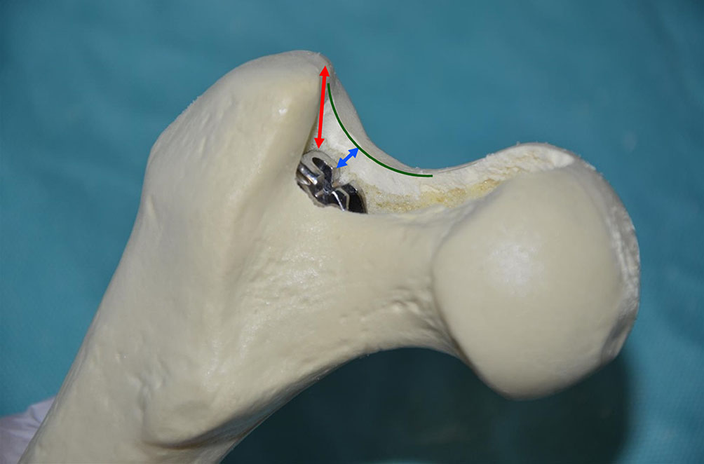 SuperPATH微创全髋关节置换手术入路图解