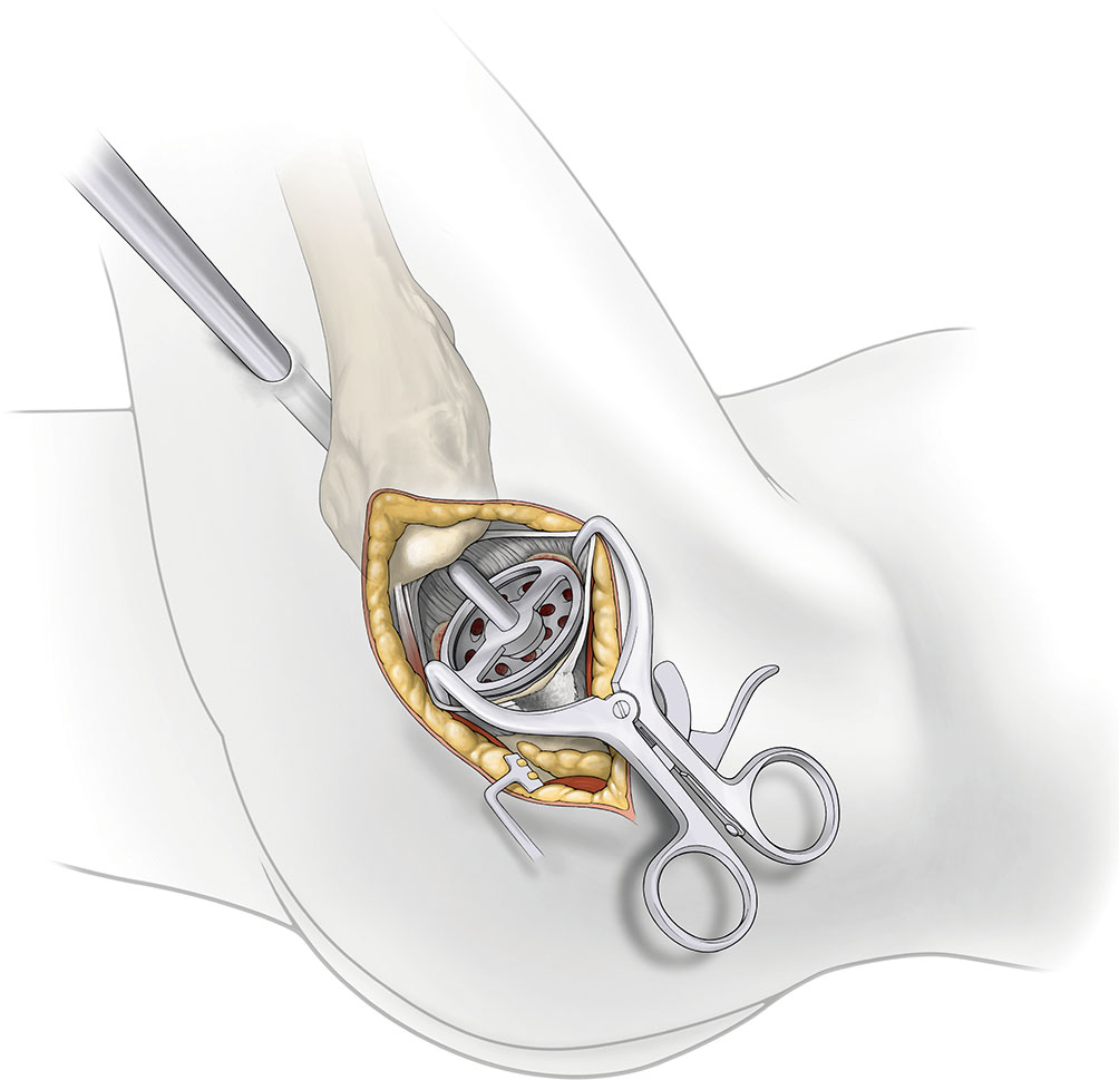 SuperPATH微创全髋关节置换手术入路图解