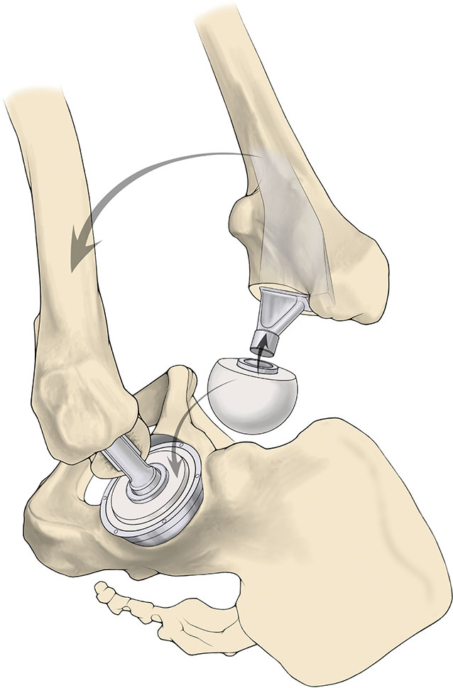 SuperPATH微创全髋关节置换手术入路图解