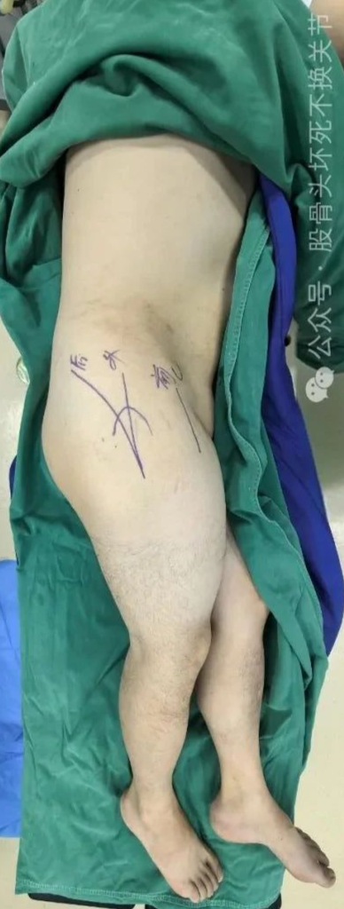 髋臼骨折4块板15颗钉，关节怎么换？