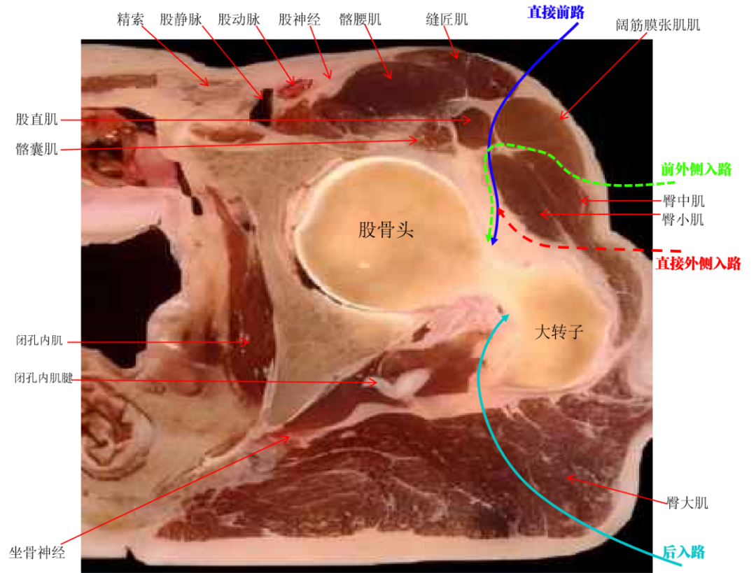 髋臼骨折4块板15颗钉，关节怎么换？