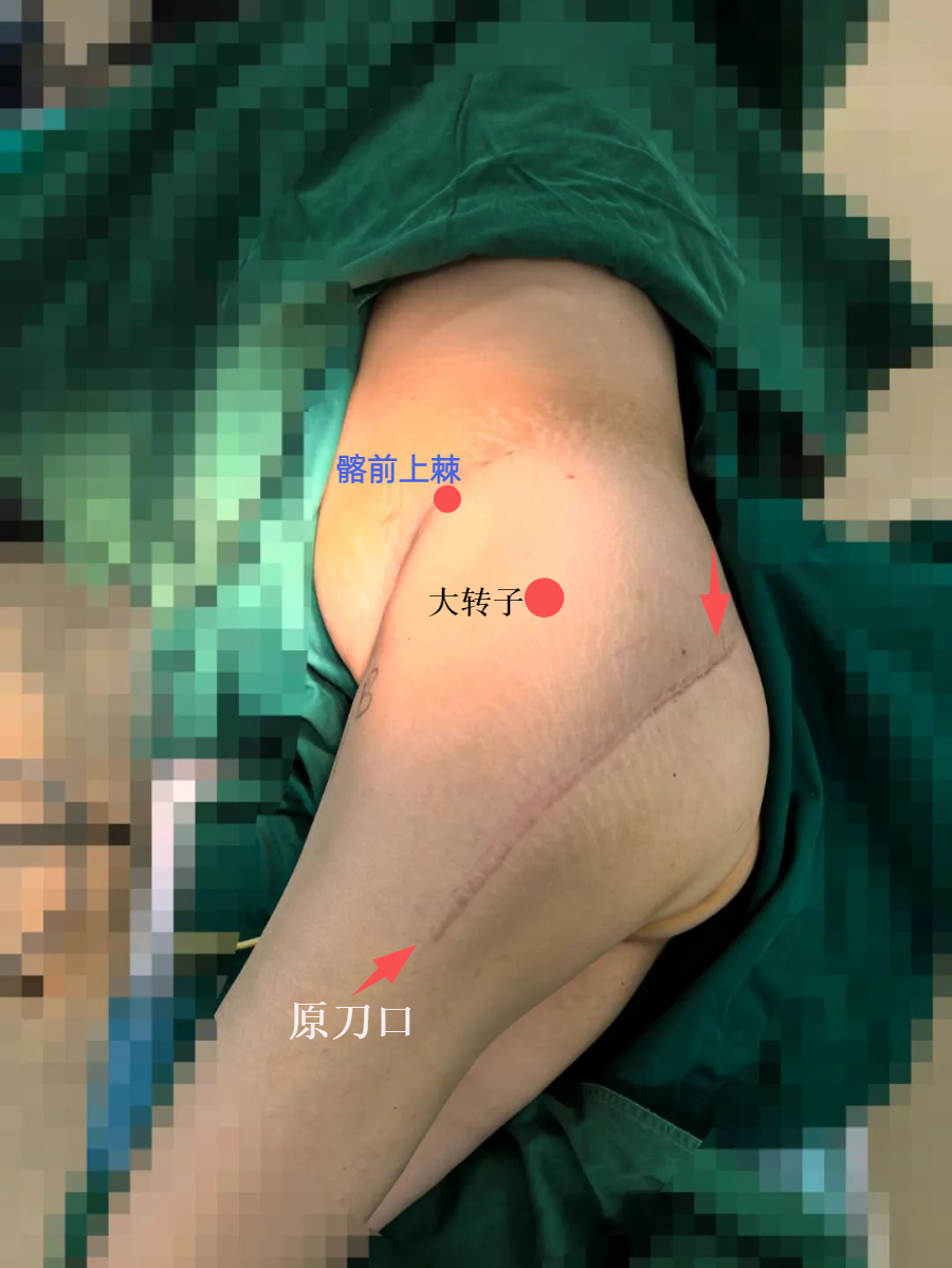 髋臼骨折4块板15颗钉，关节怎么换？