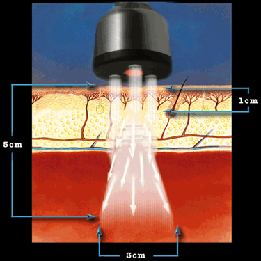康复治疗激光怎么收费【小瑞康复说】激光治疗仪助力健康_https://www.jmylbn.com_新闻资讯_第12张