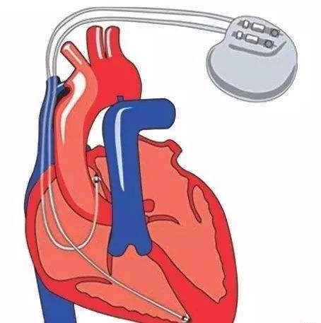 什么是中频干扰【小瑞康复说】康复理疗技术之“中频干扰电”的介绍_https://www.jmylbn.com_新闻资讯_第11张