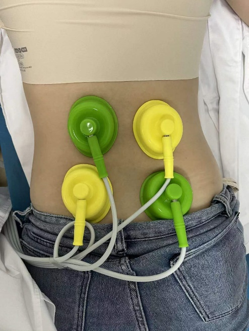 什么是中频干扰【小瑞康复说】康复理疗技术之“中频干扰电”的介绍_https://www.jmylbn.com_新闻资讯_第5张