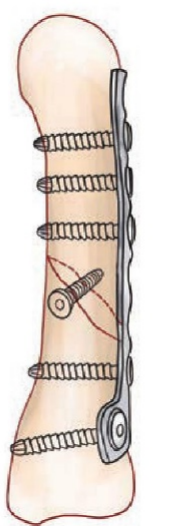 什么是中频干扰【小瑞康复说】康复理疗技术之“中频干扰电”的介绍_https://www.jmylbn.com_新闻资讯_第10张