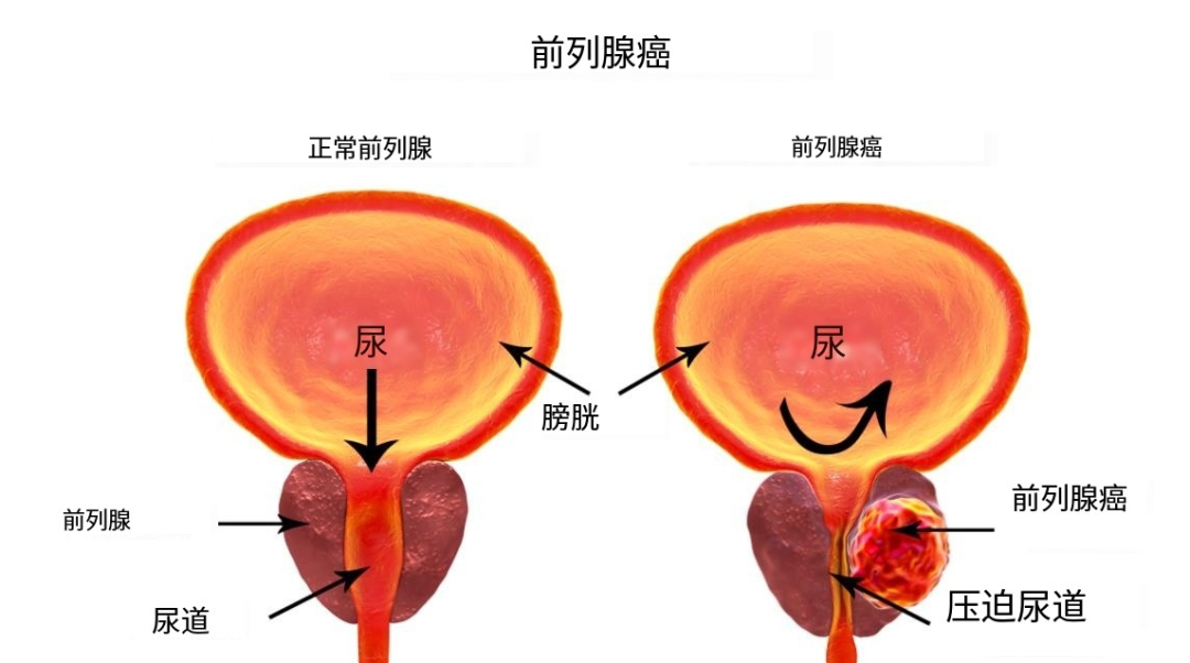 前列腺癌-可愈有道