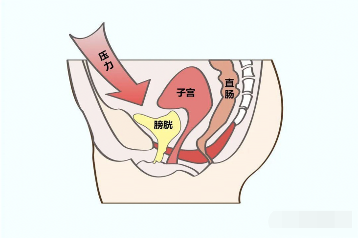 尿道张力过强怎么办【国家区域医疗中心·名医在身边】填补空白！尿道无张力悬吊术、盆底修复术已在我院泌尿外科广泛开展_https://www.jmylbn.com_新闻资讯_第5张