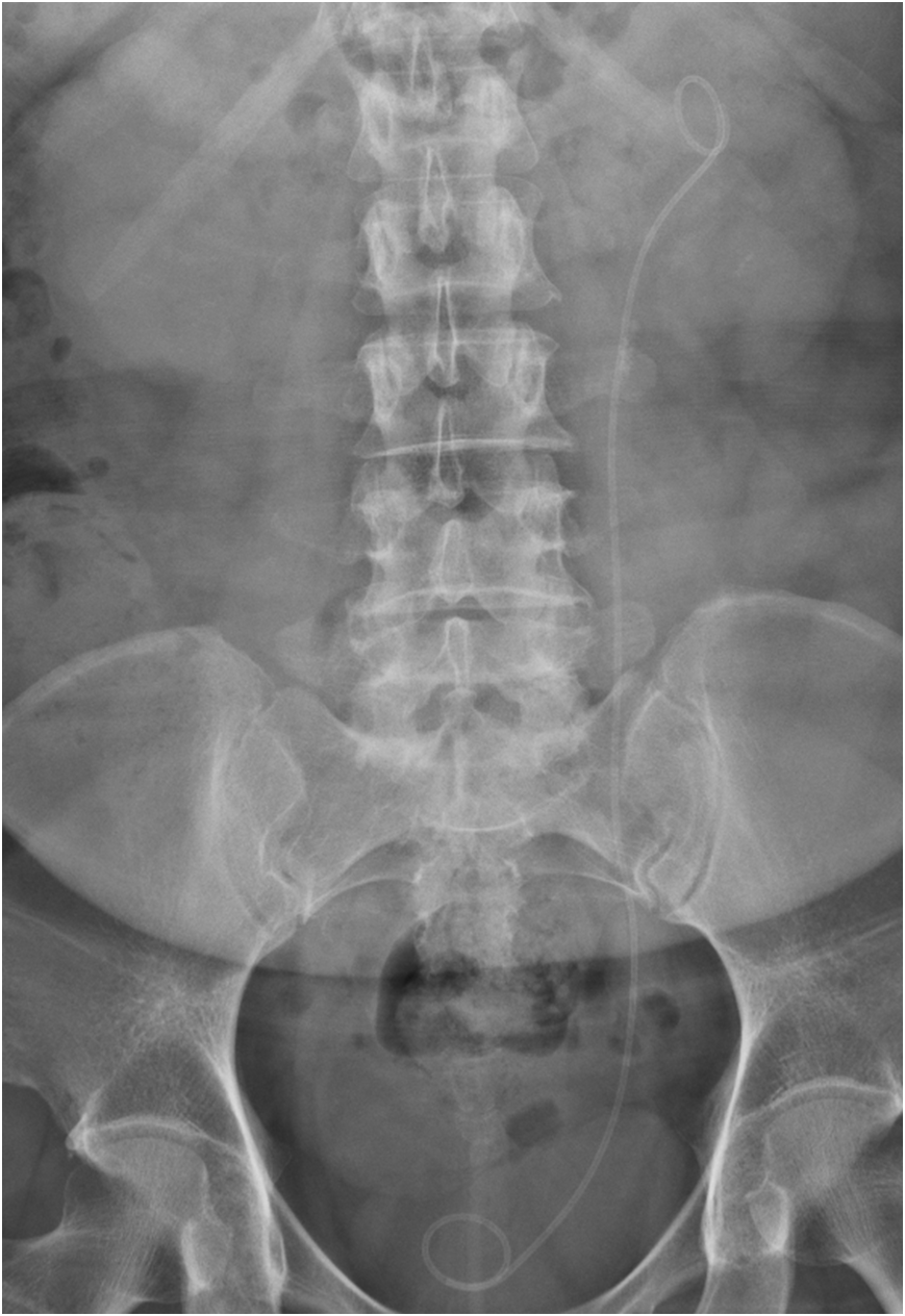 猪输尿管怎么吃“猪尾巴”遗忘在体内两年，91岁高龄老人住进ICU，泌尿外科团队巧手“拔除”_https://www.jmylbn.com_新闻资讯_第4张