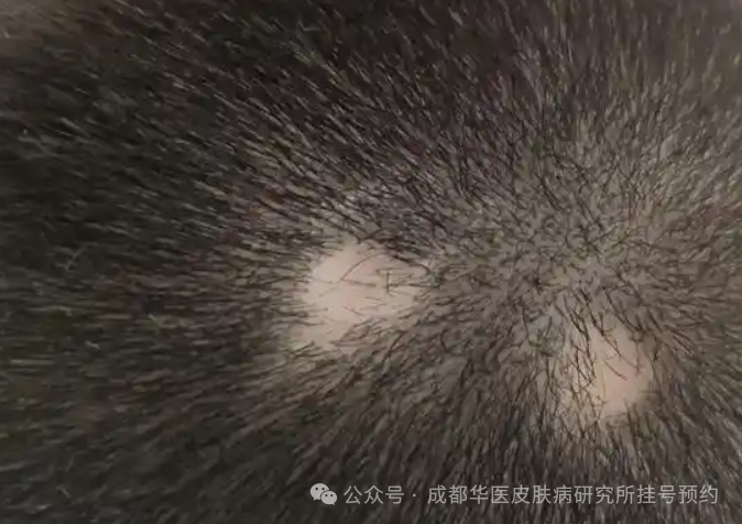 【斑秃】你不知道的原因与调理方法！宝子们，快来了：揭开斑秃的神秘面纱，找到你的健康密码