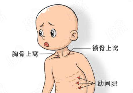 新生儿肺炎三凹征图片图片