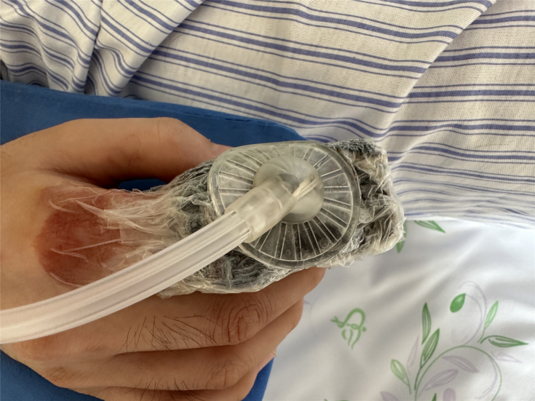 vsd引流管怎么打开护理科普 ｜ 负压封闭引流术助您伤口快速康复_https://www.jmylbn.com_新闻资讯_第5张