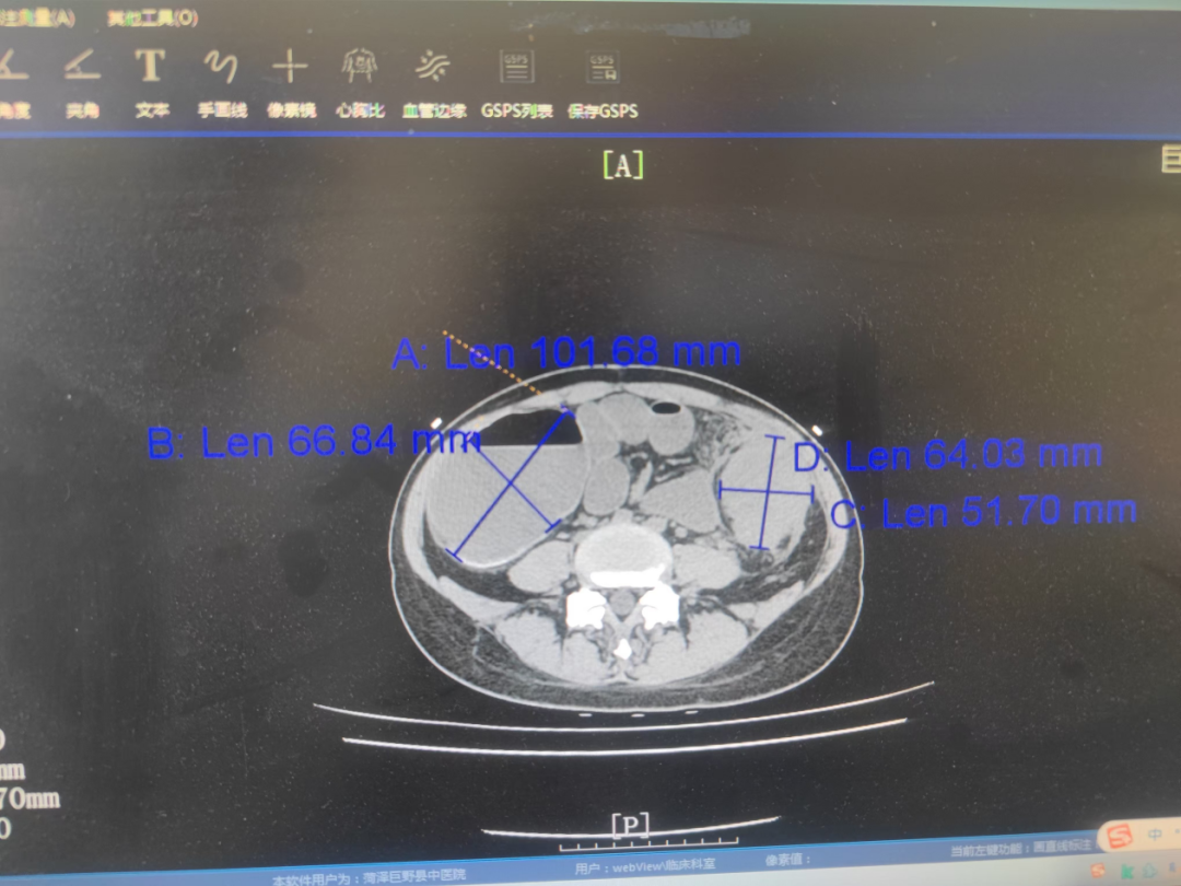 结肠灌洗怎么回事巨野县中医医院外一科成功实施急诊术中结肠灌洗Ⅰ期结肠吻合术，真正为肠梗阻患者“解困”_https://www.jmylbn.com_新闻资讯_第2张