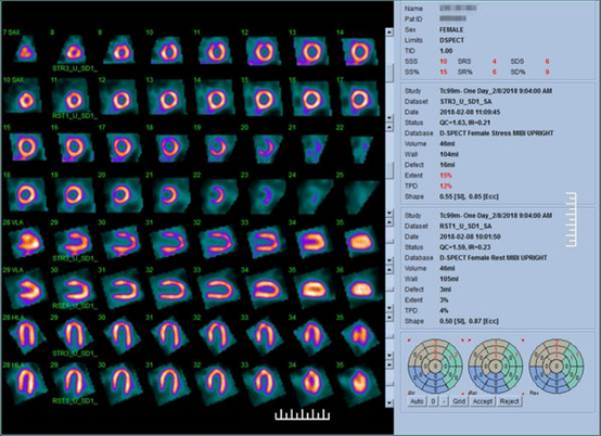 d-spect怎么检查什么是D-SPECT？_https://www.jmylbn.com_新闻资讯_第3张