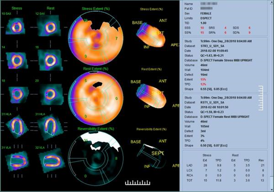 d-spect怎么检查什么是D-SPECT？_https://www.jmylbn.com_新闻资讯_第4张