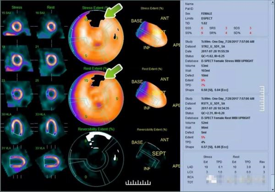 d-spect怎么检查什么是D-SPECT？_https://www.jmylbn.com_新闻资讯_第2张
