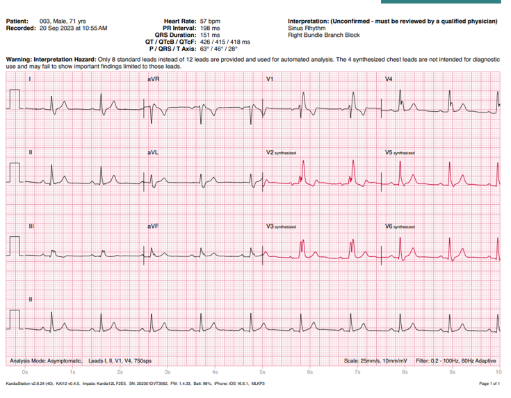 心电图机线怎么找只有“一条线”的心电图机！它是如何做到的？_https://www.jmylbn.com_新闻资讯_第6张