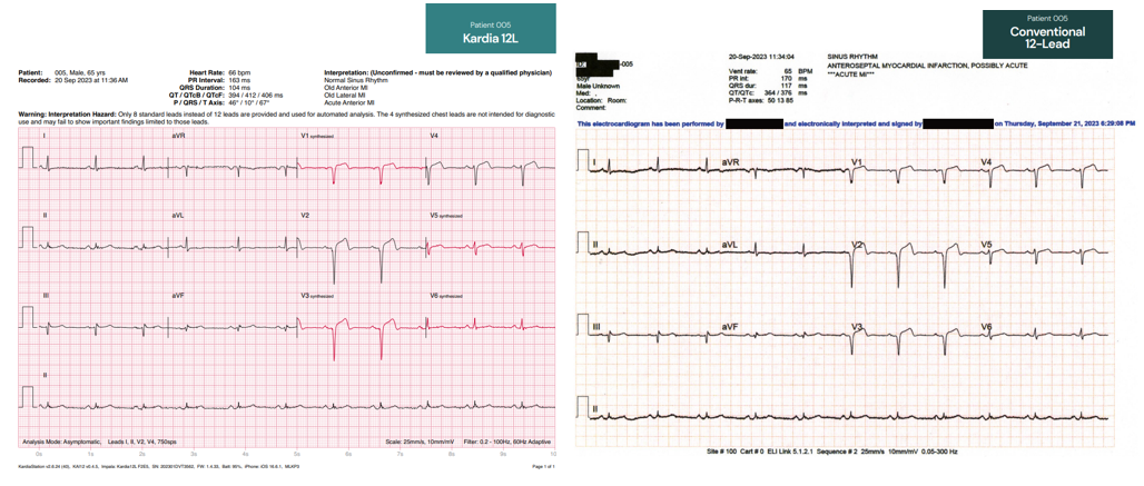 心电图机线怎么找只有“一条线”的心电图机！它是如何做到的？_https://www.jmylbn.com_新闻资讯_第21张