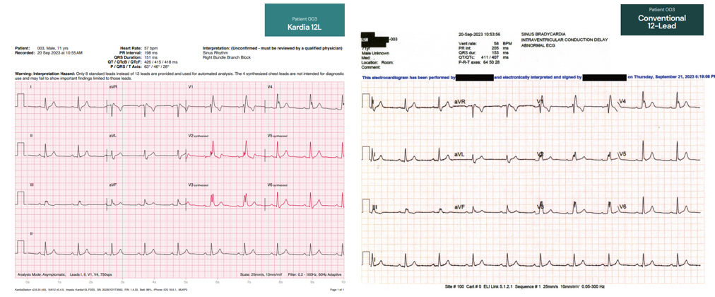 心电图机线怎么找只有“一条线”的心电图机！它是如何做到的？_https://www.jmylbn.com_新闻资讯_第20张