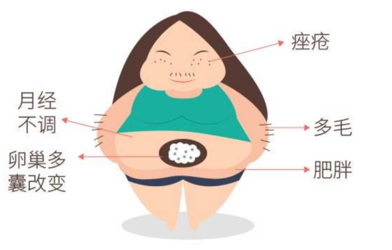 肥胖型多囊卵巢综合征怎么瘦的？啥原理？