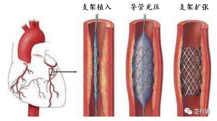 心血管支架移植模拟分析（ANSYS_APDL命令流）的图3