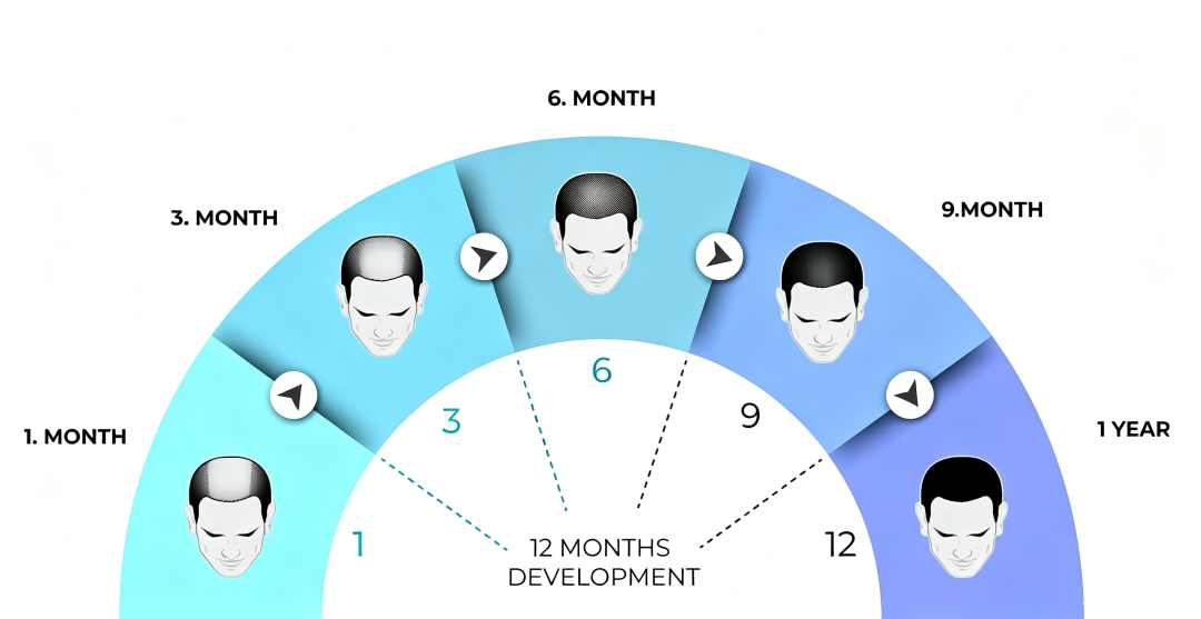 China Hair Transplant 2026 ： Costs, Recovery & Barley Guide