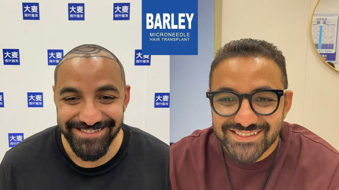 Mid-Autumn & National Day Hair Transplant Deal ： Barley Microneedle, No Shave