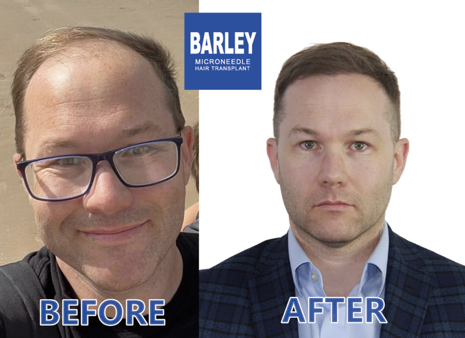 Free Scalp & Hair Consultation for Expats at Barley Hair Transplant