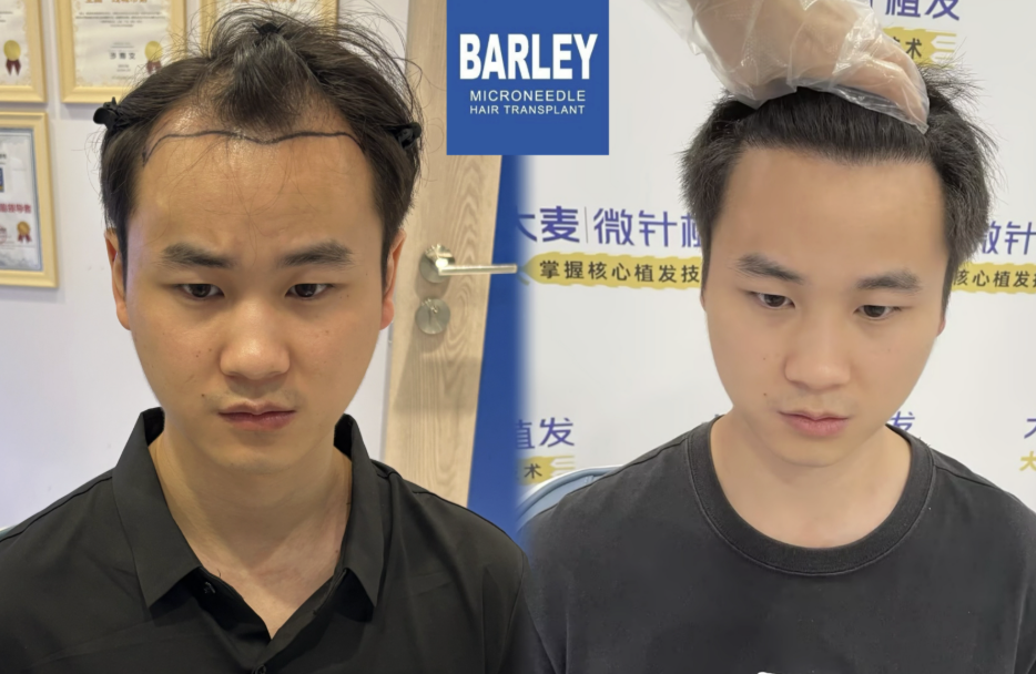 Free Scalp & Hair Consultation for Expats at Barley Hair Transplant