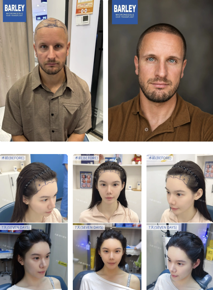 Free Scalp & Hair Consultation for Expats at Barley Hair Transplant