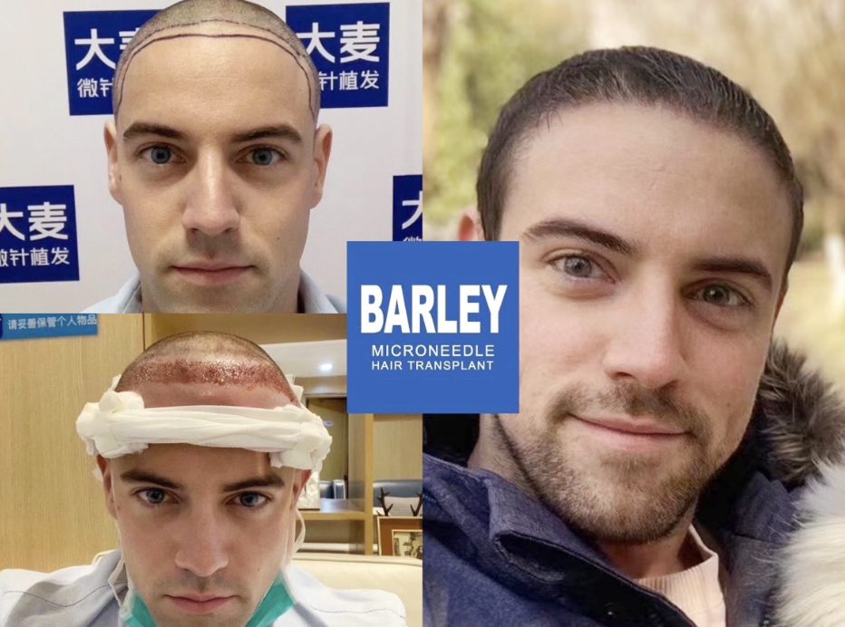 Free Scalp & Hair Consultation for Expats at Barley Hair Transplant