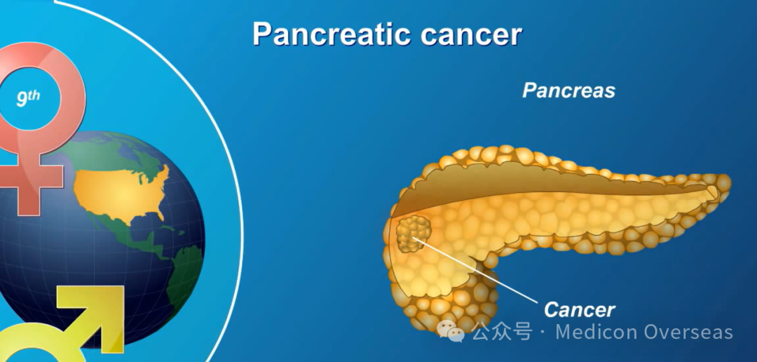 胰腺癌为什么被称为“癌症之王”？