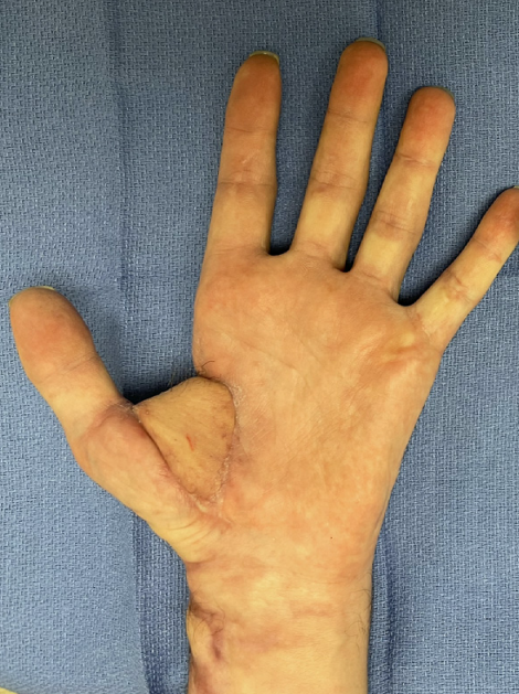 旋髂浅动脉穿支皮瓣的术前标记及切取