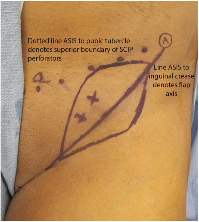 旋髂浅动脉穿支皮瓣的术前标记及切取