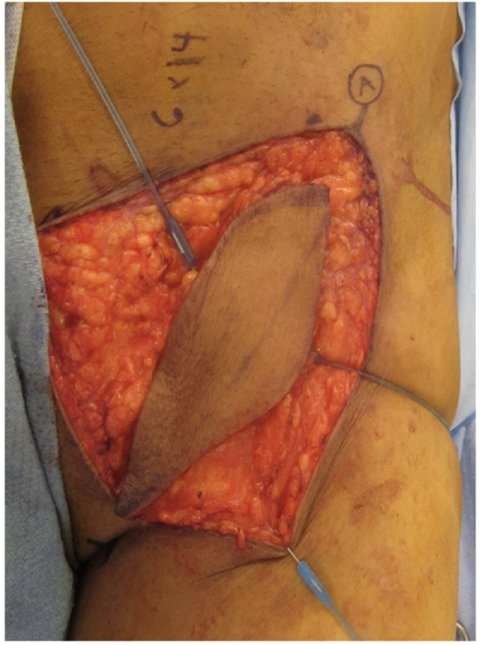 旋髂浅动脉穿支皮瓣的术前标记及切取