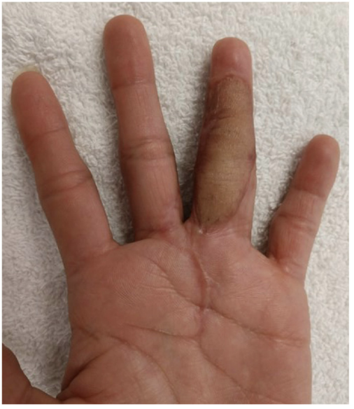 旋髂浅动脉穿支皮瓣的术前标记及切取