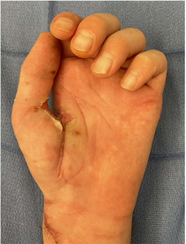 旋髂浅动脉穿支皮瓣的术前标记及切取