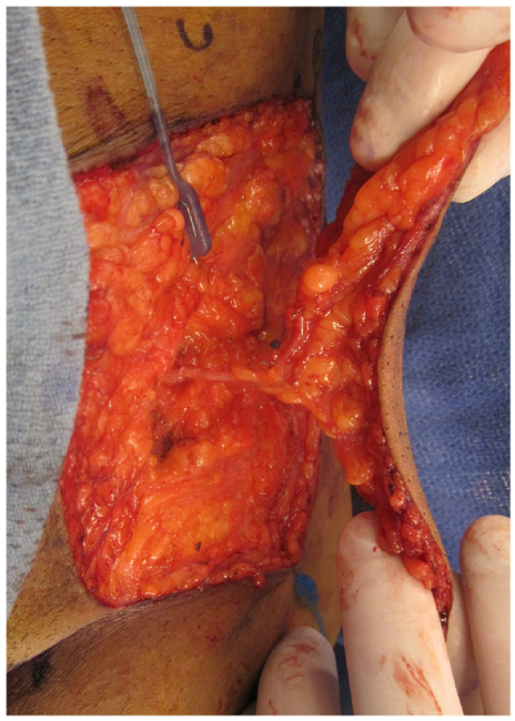 旋髂浅动脉穿支皮瓣的术前标记及切取