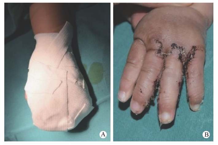 敷料包怎么打包【骨科小技巧】儿童手足畸形术后的包扎方法！_https://www.jmylbn.com_新闻资讯_第5张