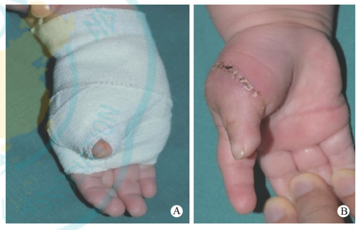 敷料包怎么打包【骨科小技巧】儿童手足畸形术后的包扎方法！_https://www.jmylbn.com_新闻资讯_第6张