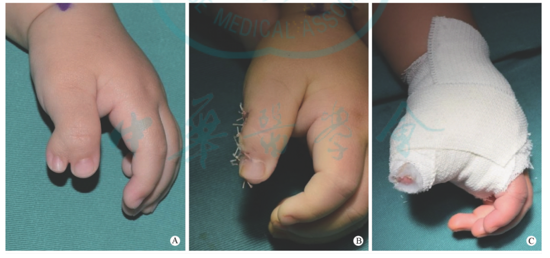 敷料包怎么打包【骨科小技巧】儿童手足畸形术后的包扎方法！_https://www.jmylbn.com_新闻资讯_第4张