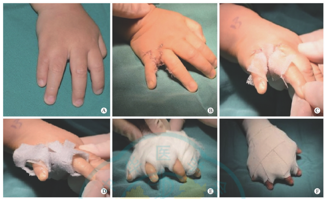 敷料包怎么打包【骨科小技巧】儿童手足畸形术后的包扎方法！_https://www.jmylbn.com_新闻资讯_第3张