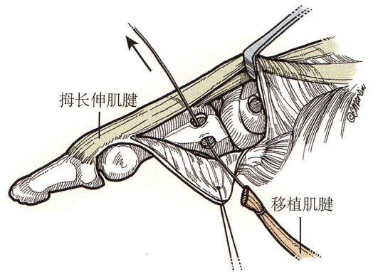 拇指掌指关节尺侧副韧带陈旧性损伤的修复