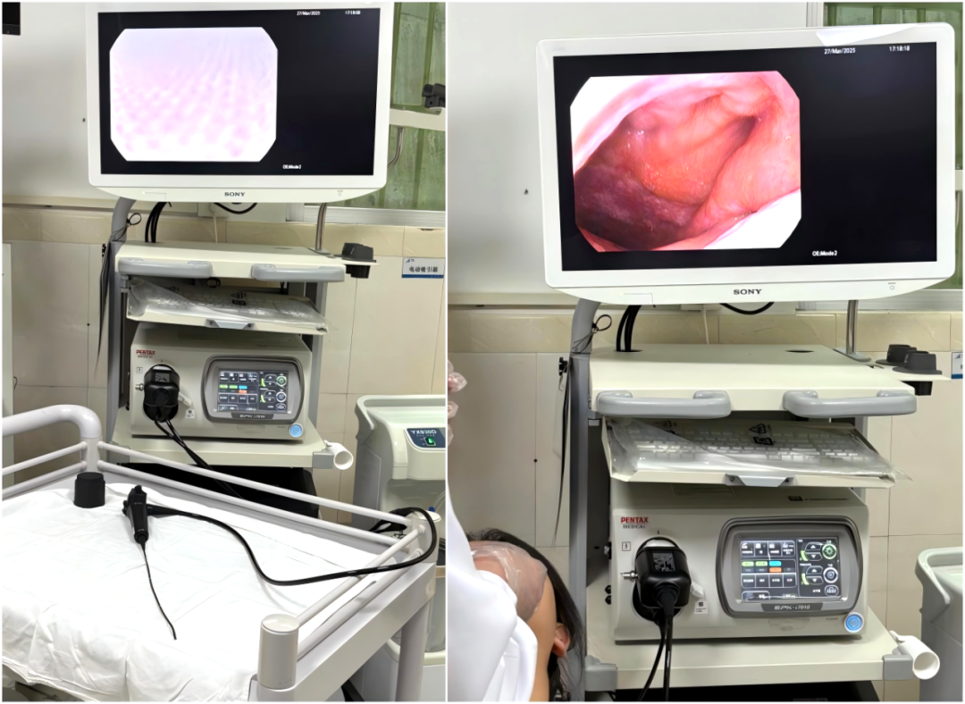 为什么喉镜后做活检【川医科普】高清电子鼻咽喉镜，让早期鼻咽喉癌无处藏身_https://www.jmylbn.com_新闻资讯_第4张